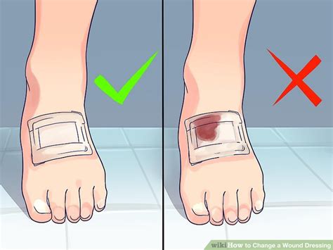 How To Change A Wound Dressing 10 Steps With Pictures Wikihow