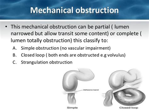 What Is Intestinal Obstruction And How Is It Treated Greenbhl