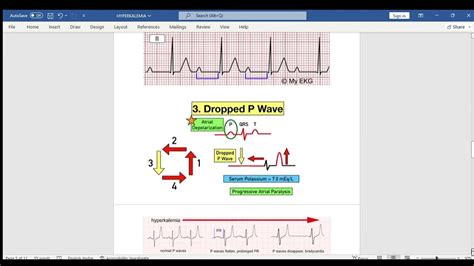 Hyperkalemia A Murder Story Youtube