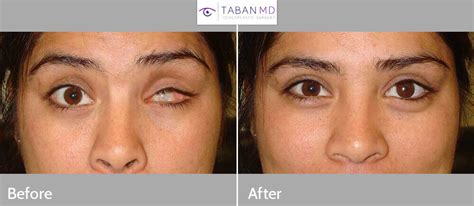 Prosthetic Eye And Socket Surgery Before And After Photos Taban Md