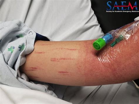 Saem Clinical Image Series Rash With Blood Pressure Cuff