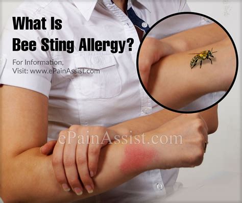 Top 97 Images Bee Sting Allergic Reaction Pictures Updated 10 2023