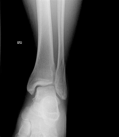 Male Patient Diagnosed With Left Weber Type B Ankle Fracture