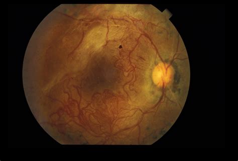 Ischemic Proliferative Diabetic Retinopathy Retina Image Bank