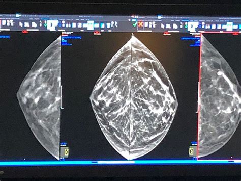 Understanding The Wait Time For Mammogram Results What Women Need To