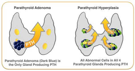 Parathyroid Gland Hyperplasia