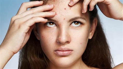 Best Acne And Pimple Prevention Tips To Avoid