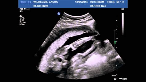 20 Week Ultrasound Baby Boy Youtube