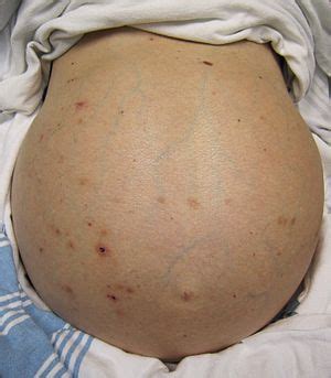 Check spelling or type a new query. Cirrhosis - Wikipedia