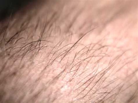 It causes nonscarring hair loss. alopecia areata fine white hair regrowth - YouTube