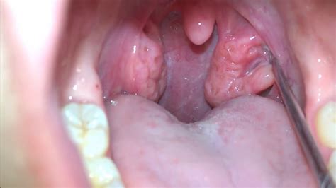 They tend to occur in people who have large or craggy tonsils. Tonsil Stone Removal (Extended Cut) - YouTube