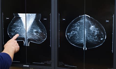 ‘we Moeten Echt Wat Doen Aan Overdiagnose Van Borstkanker