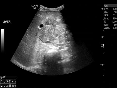 Rhabdomyosarcoma Ultrasound Wikidoc