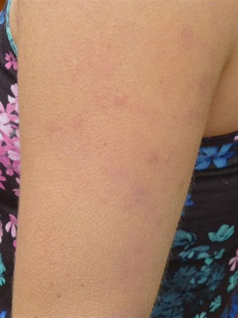How I Healed My Keratosis Pilaris Kp Naturally Part One With Images