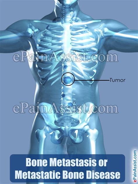 Bone Metastasis Or Metastatic Bone Diseasesymptomscausestreatment