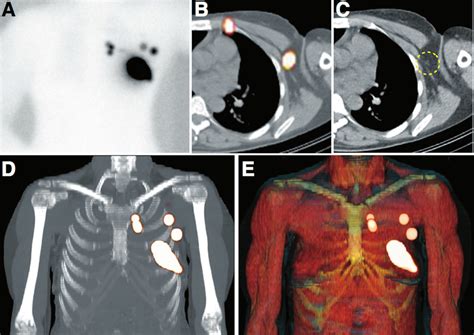 —planar Anterior Lymphoscintigraphy A Showing Ipsilateral Drainage