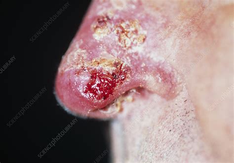 Skin Cancer On Nose Stock Image M1310372 Science Photo Library