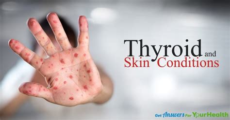 Thyroid And Skin Conditions Health Solutions Plus