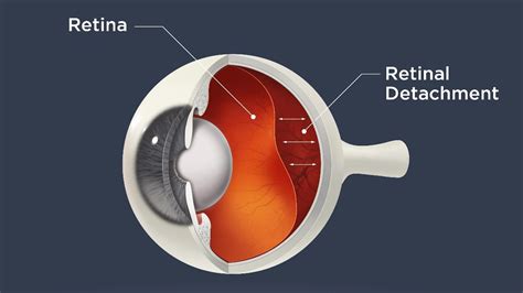 Retinal detachment - safesight eye surgery