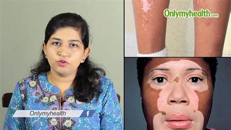 How To Recognize Vitiligo Symptoms Youtube