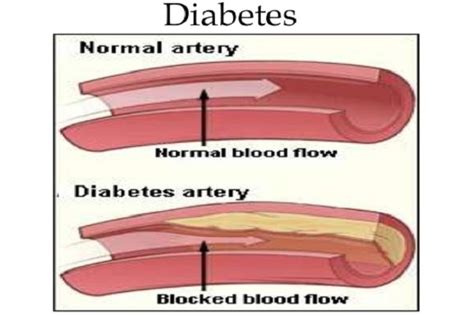 Diabetes And Vascular Disease