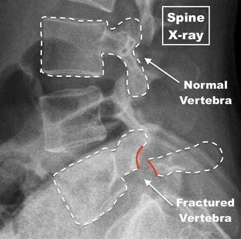 Stress Fracture Of The Spine Spondylolysis
