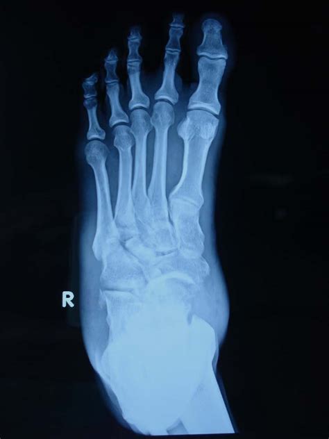 Talonavicular fracture | The Foot and Ankle Online Journal