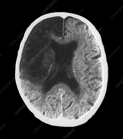 Strokes in these regions are known as a cortical strokes. Cerebral stroke, CT scan - Stock Image - C009/5369 ...