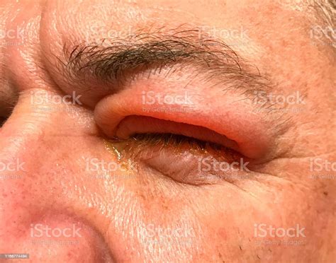 Detail Of Badly Swollen Upper Eyelid Of A Man Stock Photo Download