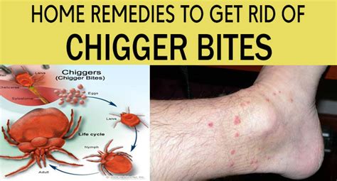 How Do You Get Rid Of Chiggers In Your Lawn
