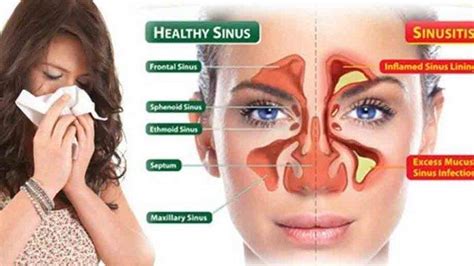 Sinusitis Gejala Penyebab Pencegahan Dan Pengobatannya