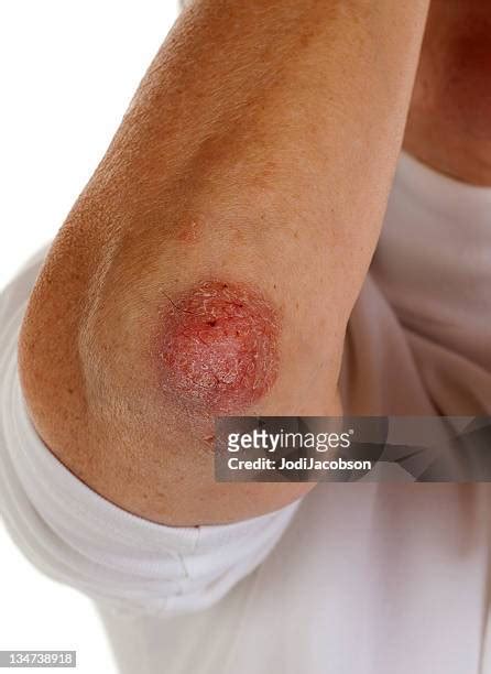 Psoriasis Elbows Photos And Premium High Res Pictures Getty Images