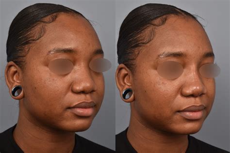 Non Surgical Rhinoplasty Patient 1 • Pearlman Aesthetic Surgery