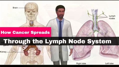 How Cancer Spreads Through The Lymph Node System Male Health Clinic