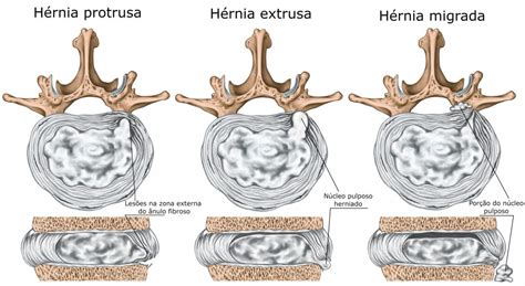 Hérnia De Disco Tipos Causas Sintomas Tratamentos Ortopedia