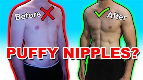 How I Got Rid Of My Puffy Nipples Without Surgery Youtube