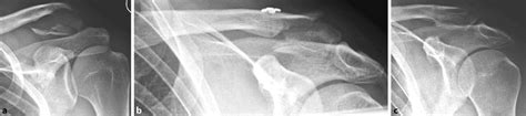 8 A Lateral Clavicle Fracture Jäger And Breitner Iianeer Iib B