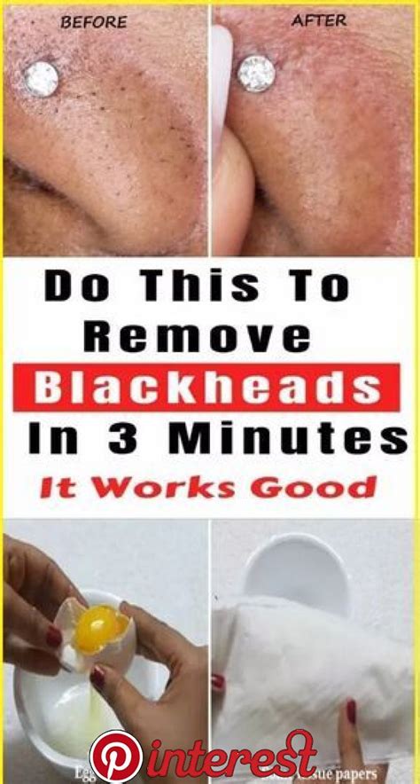 Remove Blackheads With One Simple And Effective Trick Diëten Tips En Gezond