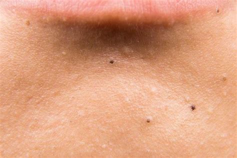 How To Get Rid Of Black Spots On Skin