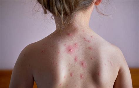 Signs And Symptoms Of Chicken Pox