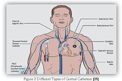 Figure 2 From When Picc Lines Are Not Clinically Indicated