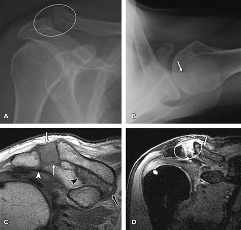 Mri Versus Radiography Of Acromioclavicular Joint Dislocation Ajr