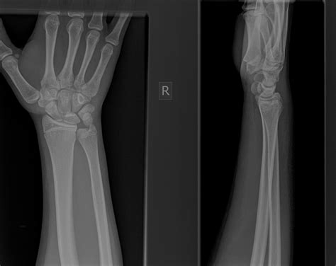 Icd 10 Code For Left Wrist Distal Radius Fracture