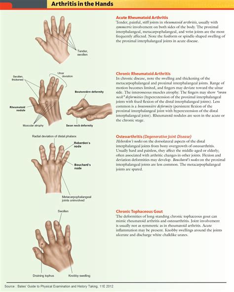 Common Forms Of Arthritis In The Hands Acute Rheumatoid Grepmed