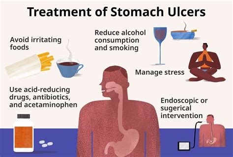Stomach Ulcer Types Causes And Symptoms 43 Off