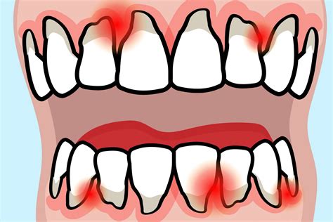 What Gum Disease Reveals About Rheumatoid Arthritis Disease Activity