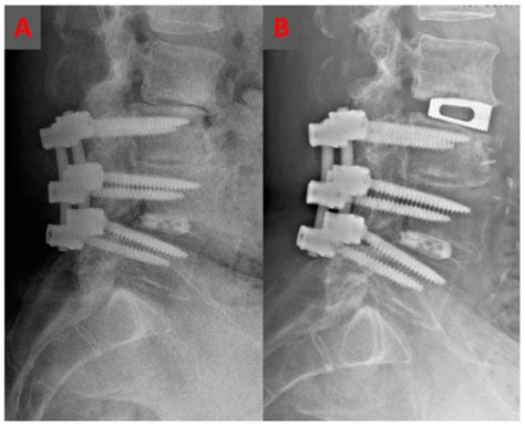 Jcm Free Full Text Stand Alone Oblique Lumbar Interbody Fusion