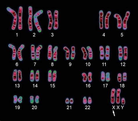 Klinefelter Syndrome Definition Symptoms Treatment And Life