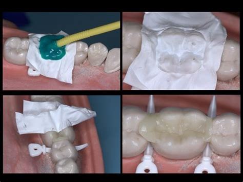 Has Anyone Ever Tired The Occlusal Stamp Technique For An Mod Composite
