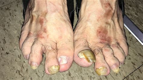 UGLY Toenail Pedicure! - YouTube